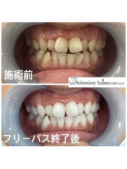 ホワイトニングサロン 京都烏丸店/ホワイトニング施術例