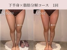 ミア(miiia)/下半身×脂肪分解コース　1回