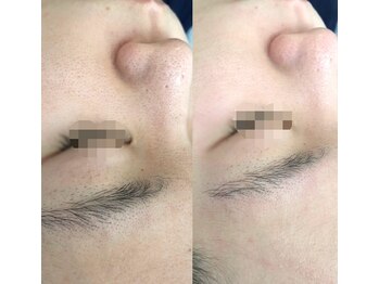 グレース(Grace luxe)の写真/毛穴悩みに根本アプローチ♪陶肌トリートメントで黒ずみ・開き・詰まりを解消!繰り返さない毛穴レス肌へ