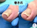 巻き爪矯正は専門店へ●