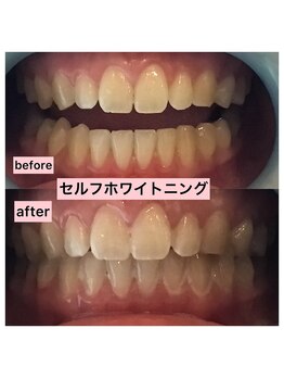 エスデザイン(es design)/セルフホワイトニング/鹿児島