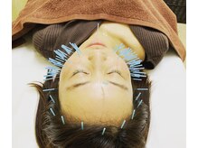 皇漢堂鍼灸療院/今までの美容鍼では満足できない