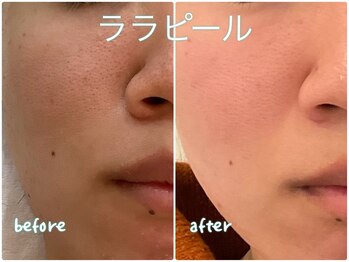 プレヴェール 神戸三宮/ララピール ツヤっと明るい肌に