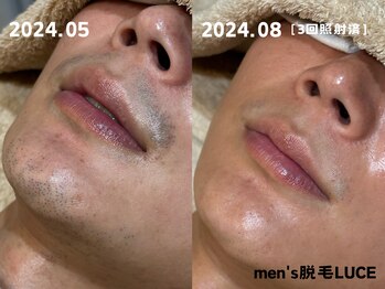 ルーチェ/【ヒゲ脱毛】と言えばルーチェ