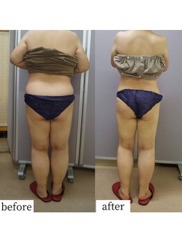 アップルミント/＜痩身＞before・after