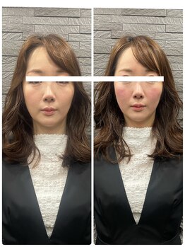 長寿鍼灸院 長寿整骨院/ハリネズミ女優美容鍼効果★