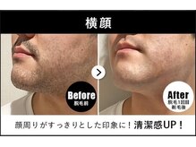 RBL 池袋店/メンズ脱毛/ヒゲ脱毛1回目剃毛後