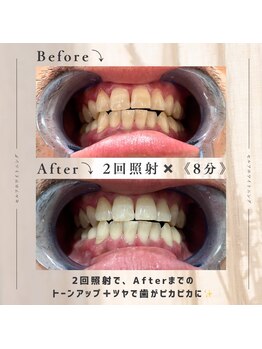 エイム(EIM)/セルフホワイトニング