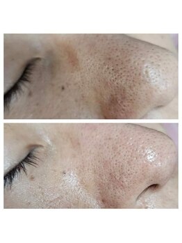 エターナル(Eternal)/メンズ専用 毛穴ケア