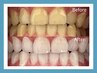 【回数券お持ちのお客様からの紹介】美白ホワイトニング40分なんと¥1500