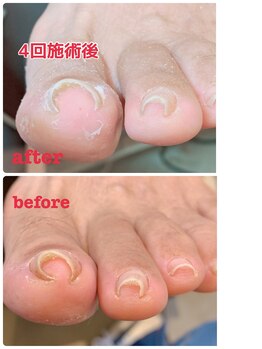 ナナ 名護店(NANA)/巻き爪緩和ケア