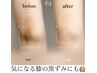 【韓国最新黒ずみケア】ルメラ◎気になるボディーのメラニンケア♪肘/膝/脇