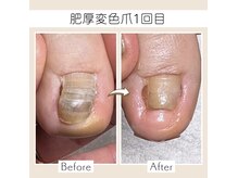 爪屋ソウジロウ(SOJIRO)の雰囲気（分厚く変色し伸びてこなくなった爪。伸びてくるようアプローチ。）