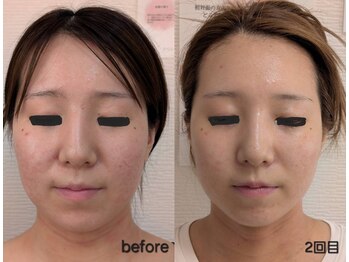 レゾン 京橋店/【Before/after】最新韓国美容★