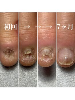 深爪矯正/重ダメージ/7ヶ月経過