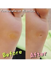 ニコルル 春日部店(Nicolulu)/魚の目ビフォーアフター