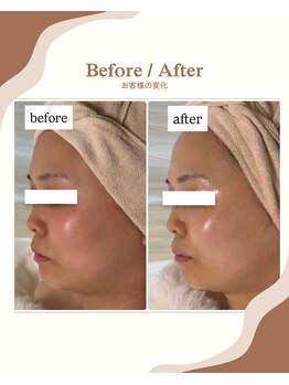 エムイーボーテ(me.Beaute)/【セルマン】本気の肌質改善ケア