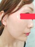【韓国肌管理】話題のセルマン★本格ピーリングで艶玉肌育体験！￥22000→