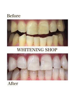ホワイトニングショップ 泉佐野店/フリーパスコースbefore after