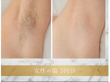 アンド エヌ(&n)/◆脇脱毛◆