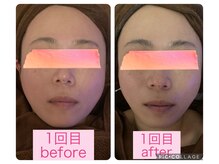 ベルフルールエム(Belle Fleur.M)/顔筋小顔フェイシャル☆