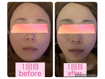 ベルフルールエム(Belle Fleur.M)/顔筋小顔フェイシャル☆