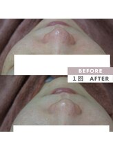 アップルミント/＜フェイシャル＞before・after