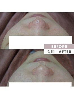 アップルミント/＜フェイシャル＞before・after