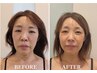 【撮影モニター割引】体験価格より50%off★お得にたるみ改善◎若見え小顔