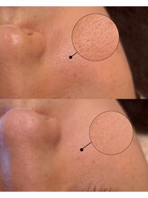 エル(Elle)/毛穴を引き締める剥離なしハーブ