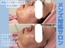 メンズ対応サロン★ハーブピーリング￥12,300～