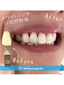 ホワイトニングカフェ 池袋東口店/ホワイトニングビフォーアフター