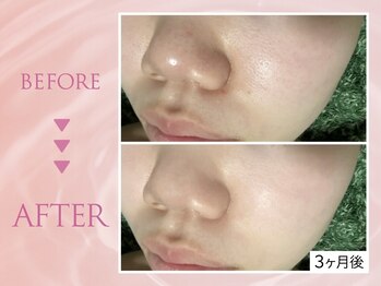 クリアラボ 池袋2nd(Clear Lab)/韓国肌管理&毛穴洗浄専門店