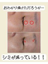 ブレリアントサロン 池袋店(brillant salon)/シミケア1回のビフォーアフター