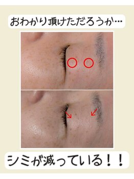 ブレリアントサロン 池袋店(brillant salon)/シミケア1回のビフォーアフター