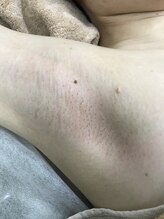 ナノハナ/鹿沼市本格全身脱毛ナノハナ