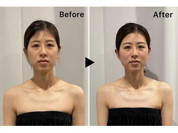 レミュー(Les mieux)/若々しく引き締まったお顔へ