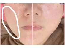 アトリエ ハルミナ(atelier harumina)/お肌プルプルとお顔もスッキリ