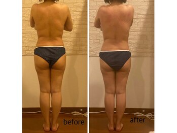 うつくし痩身 美サロン ゼットワン(Z-ONE)/ボディ　メディセル＋マッサージ