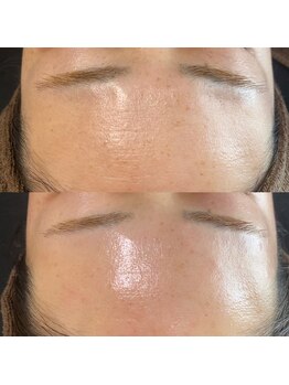 ナチュウル(Natulu)/シルク糸脱毛＊小じわ改善