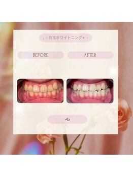 プラスビー 2号店(+b)/ホワイトニングビフォーアフター