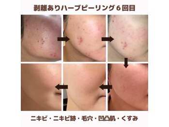 ダブリュービー(WB)/ハードハーブピーリング6回目