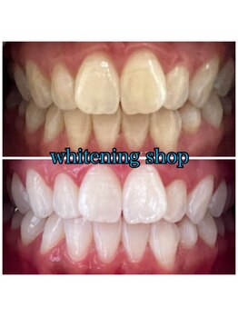 ホワイトニングショップ 船橋2号店/Before&After美白ホワイトニング