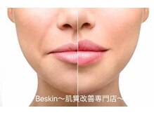 ビースキン 広島(BE:SKIN)
