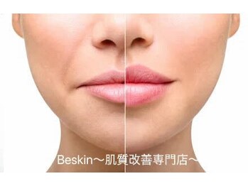 ビースキン 広島(BE:SKIN)の写真/肌質改善専門店だから叶う【毛穴洗浄＋光フォト】で緩んだ顔筋UP&ホウレイ線・たるみ改善【リフトアップ】