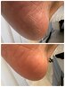 Foot：【足裏角質ケア＋ワンカラー】におい対策にも◎￥11000