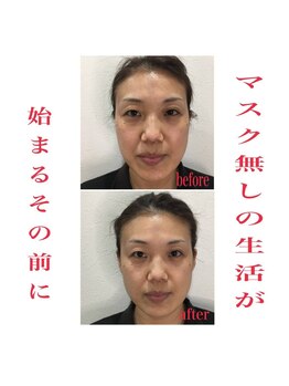 カロンボーテ(Calon beaute)/最新ラジオ波でほうれい線撃退！