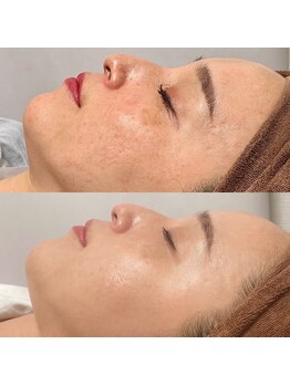 ティアラ 葛西店(TIARA)/TIARAハーブピーリング