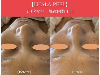 リプロ(RePro)/ララピール ビフォーアフター