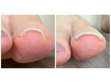 カラーホリック ネイルスパ(Colorholic Nailspa)の雰囲気（3種類から選べる巻き爪補正はお客様の生活に合った方法をご提案）